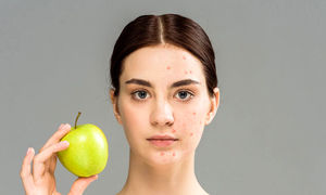 ۵ ماده غذایی مضر که باعث ایجاد جوش و آکنه می‌شود