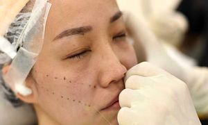 5 نکته مهم درباره مزایا و هزینه لیفت صورت با نخ در اصفهان