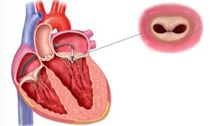 گشادی دریچه قلب چیست و چگونه درمان می شود؟