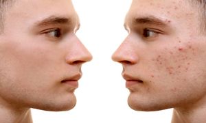 عرضه سرم برطرف کننده جوش صورت دیپ‌ سنس